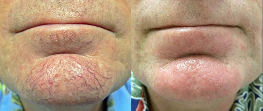 Before and after — IPL Laser, broken capillaries & redness