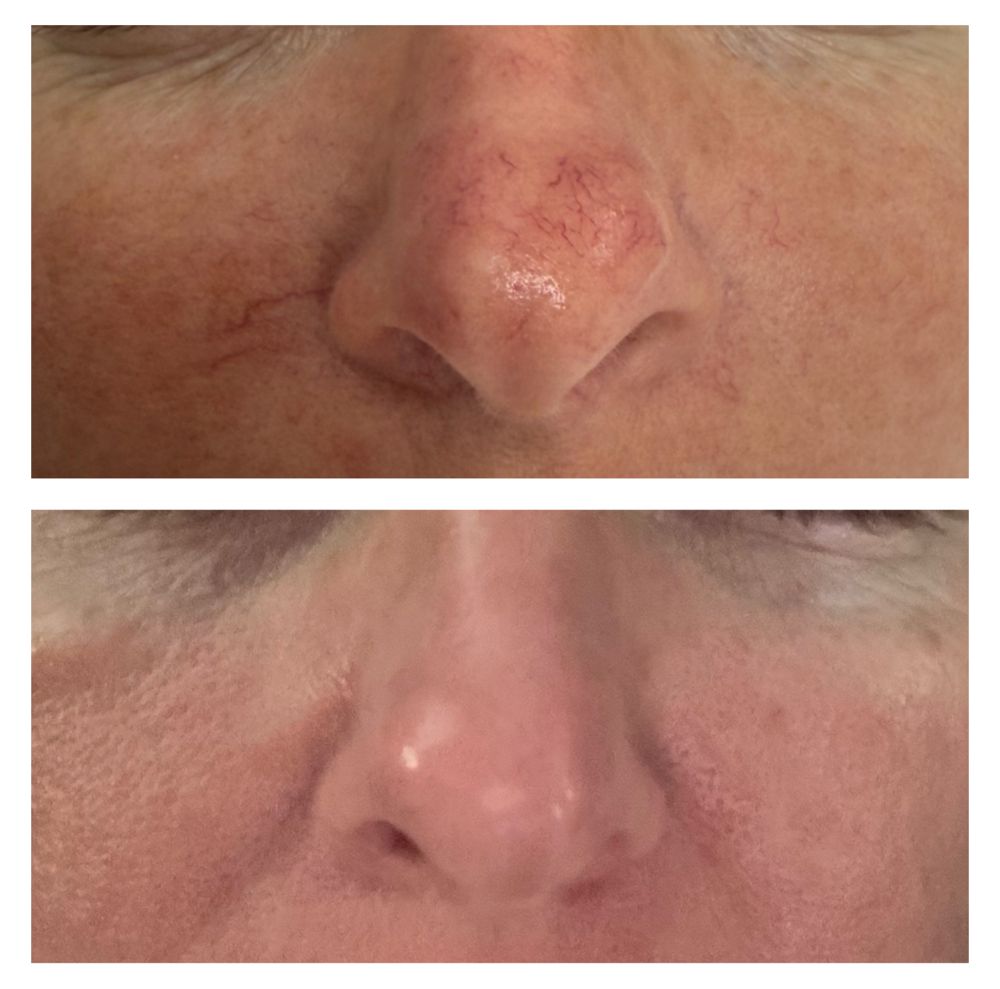 Before and after — IPL Laser, broken capillaries & rosacea