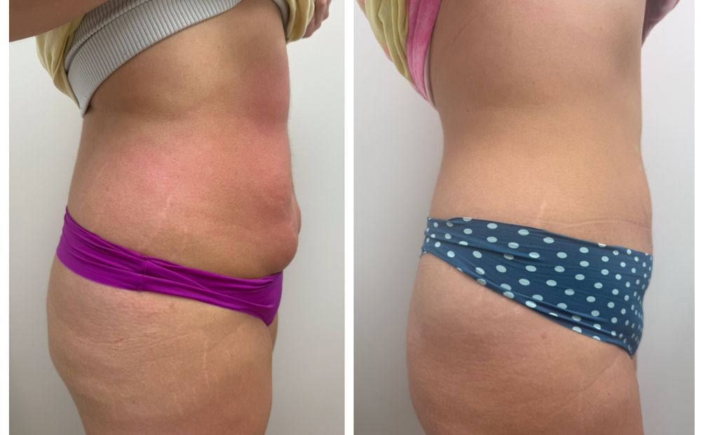 Before and after — Radio Frequency, body contouring & skin tightening