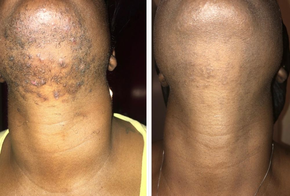 Before and after — Laser Hair Removal, smoother skin, reduced ingrowns