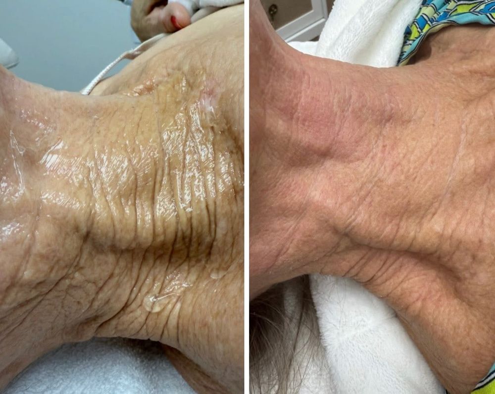 Before and after — Fractional Resurfacing Laser, crepey skin, fine lines & wrinkles