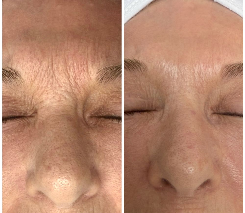 Before and after — Microneedling, fine lines & wrinkles