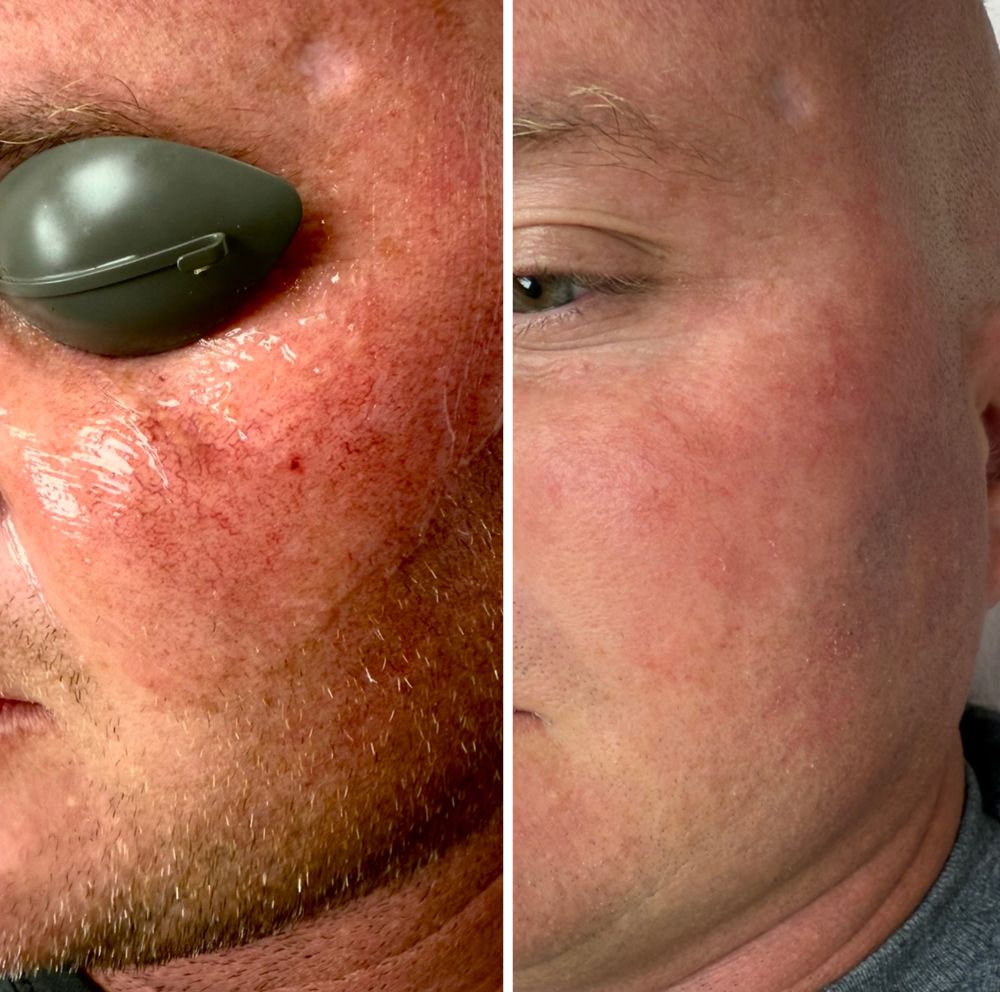 Before and after — IPL Laser, rosacea & facial redness