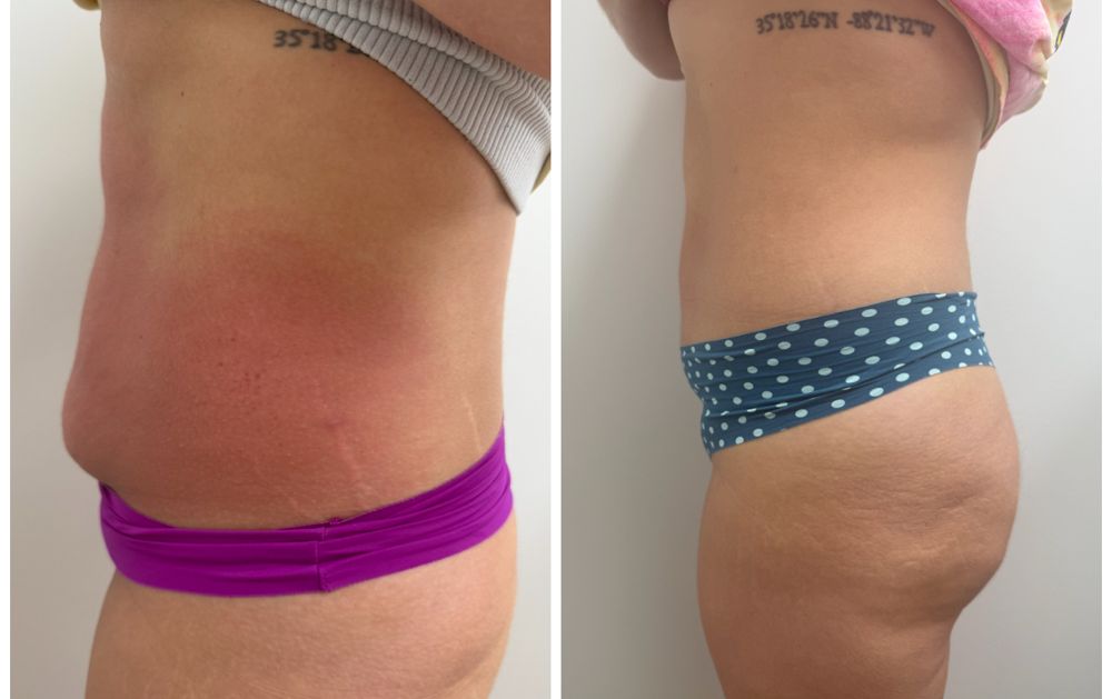Before and after — Radio Frequency, body contouring