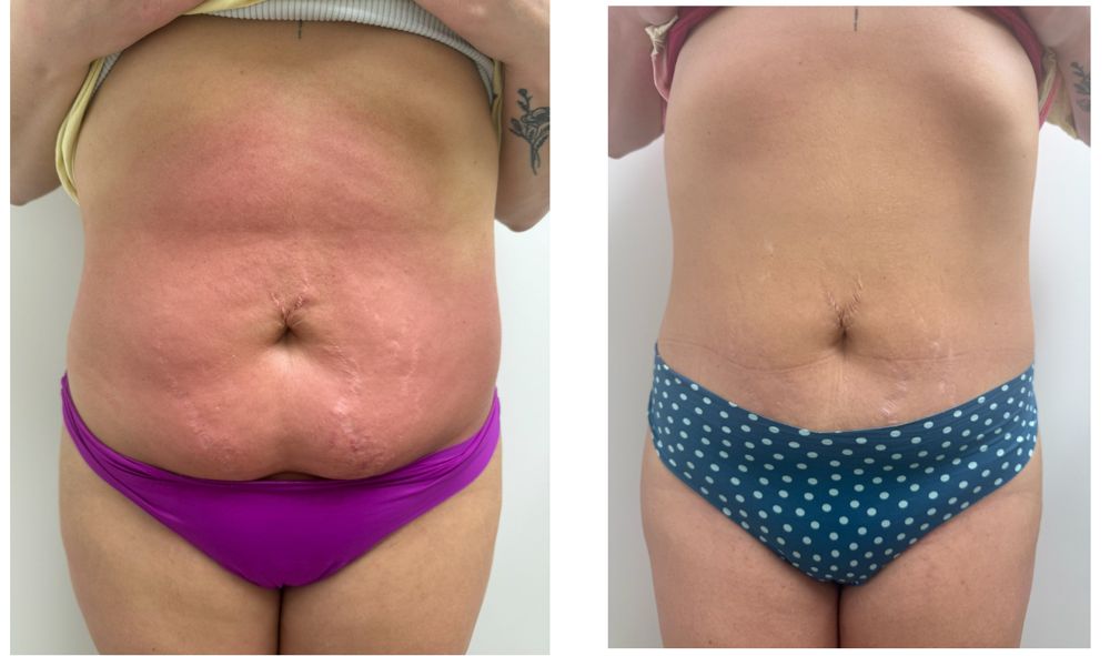 Before and after — Radio Frequency, skin tightening & fat reduction