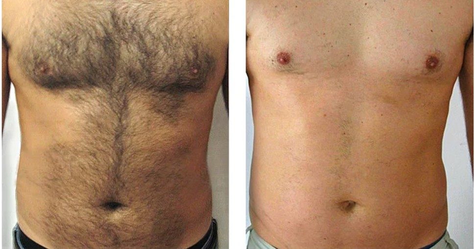 Before and after — Laser Hair Removal, chest — hair reduction
