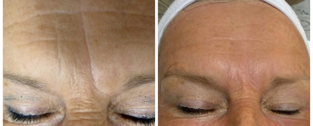 Before and after — Microneedling, forehead lines