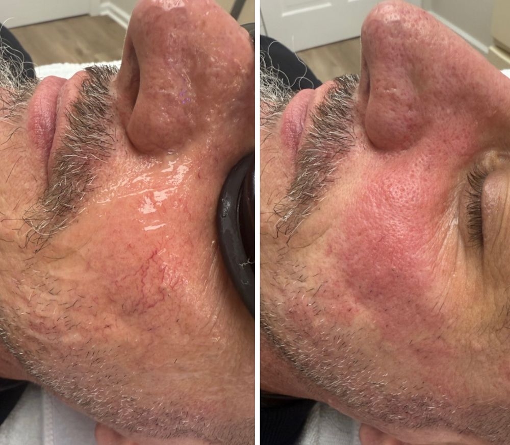 Before and after — IPL Laser, broken capillaries