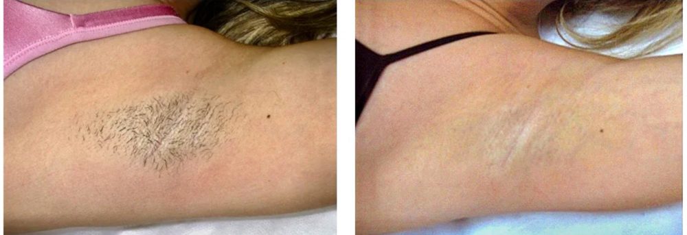 Before and after — Laser Hair Removal, underarm — hair reduction