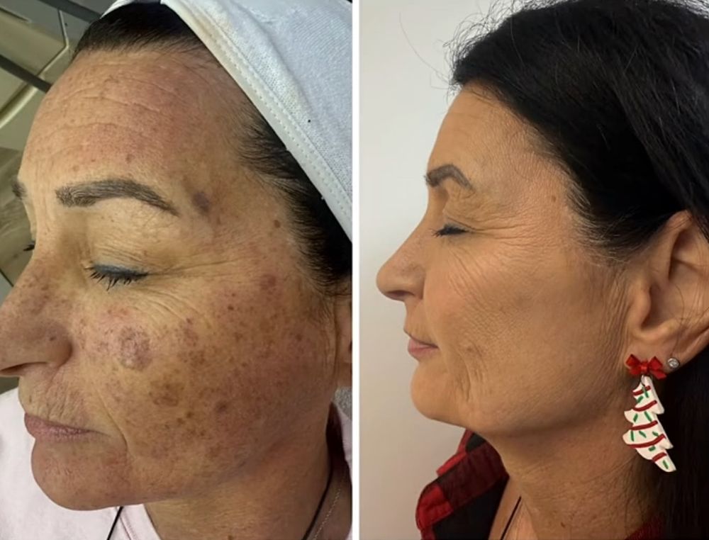 Before and after — IPL Laser, sun damage & age spots