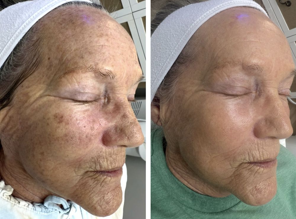 Before and after — IPL Laser, sun damage & pigmentation