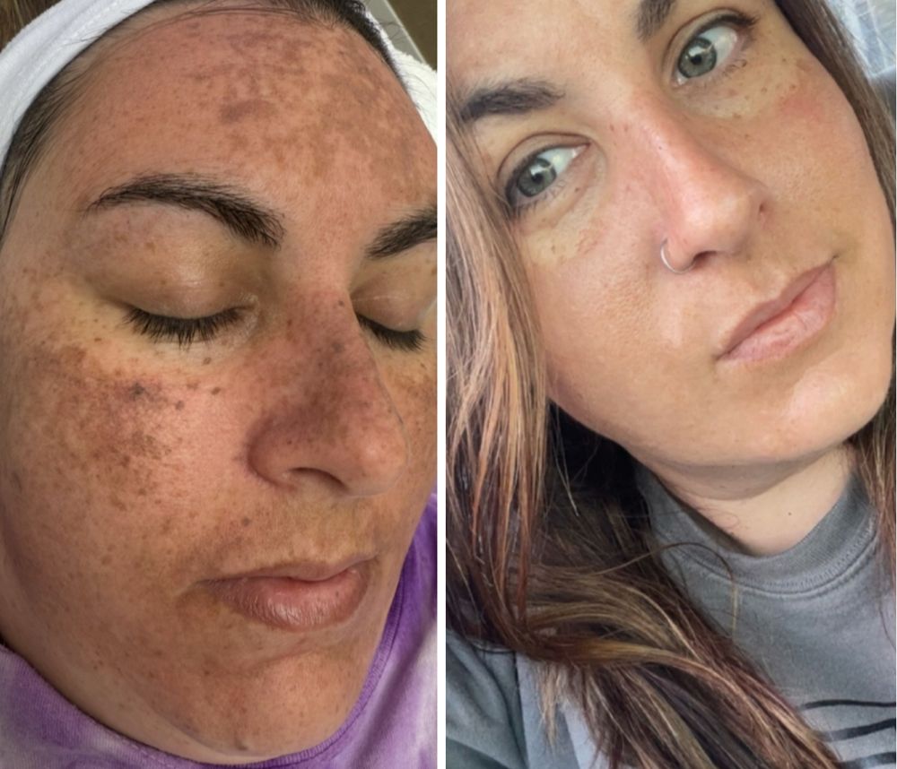 Before and after — IPL Laser, melasma & pigmentation