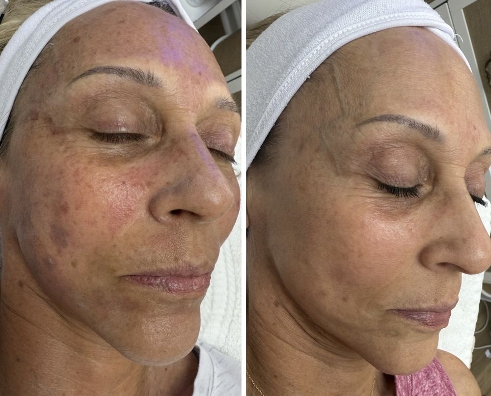 Before and after — IPL Laser, sun damage & age spots