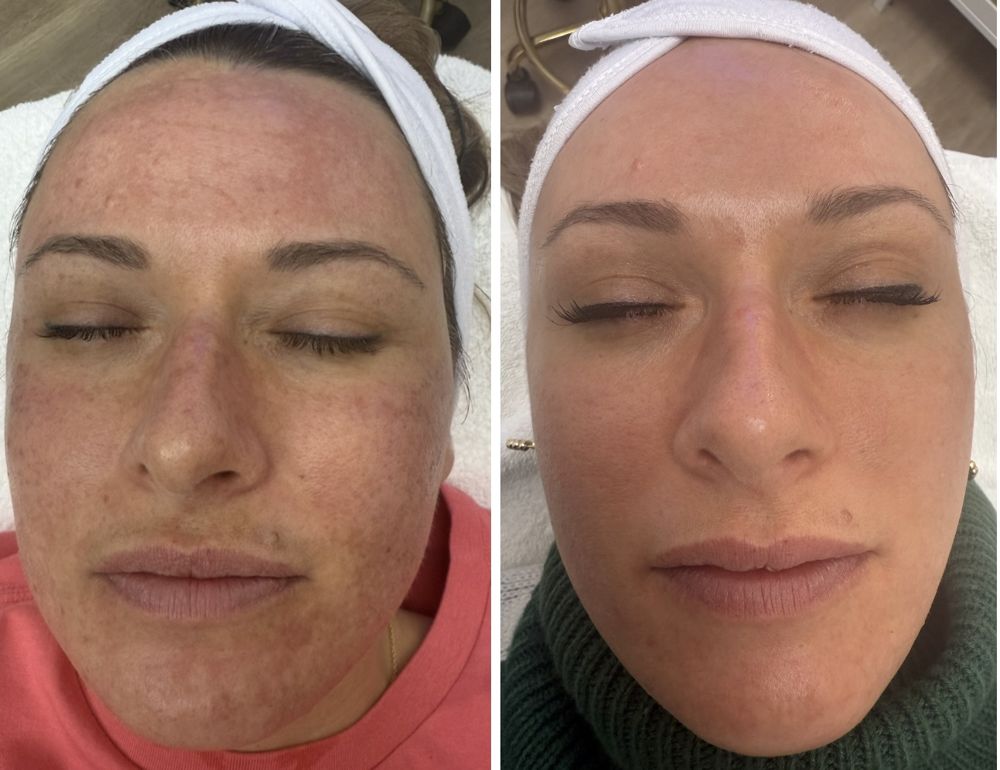 Before and after — IPL Laser, sun damage & uneven tone