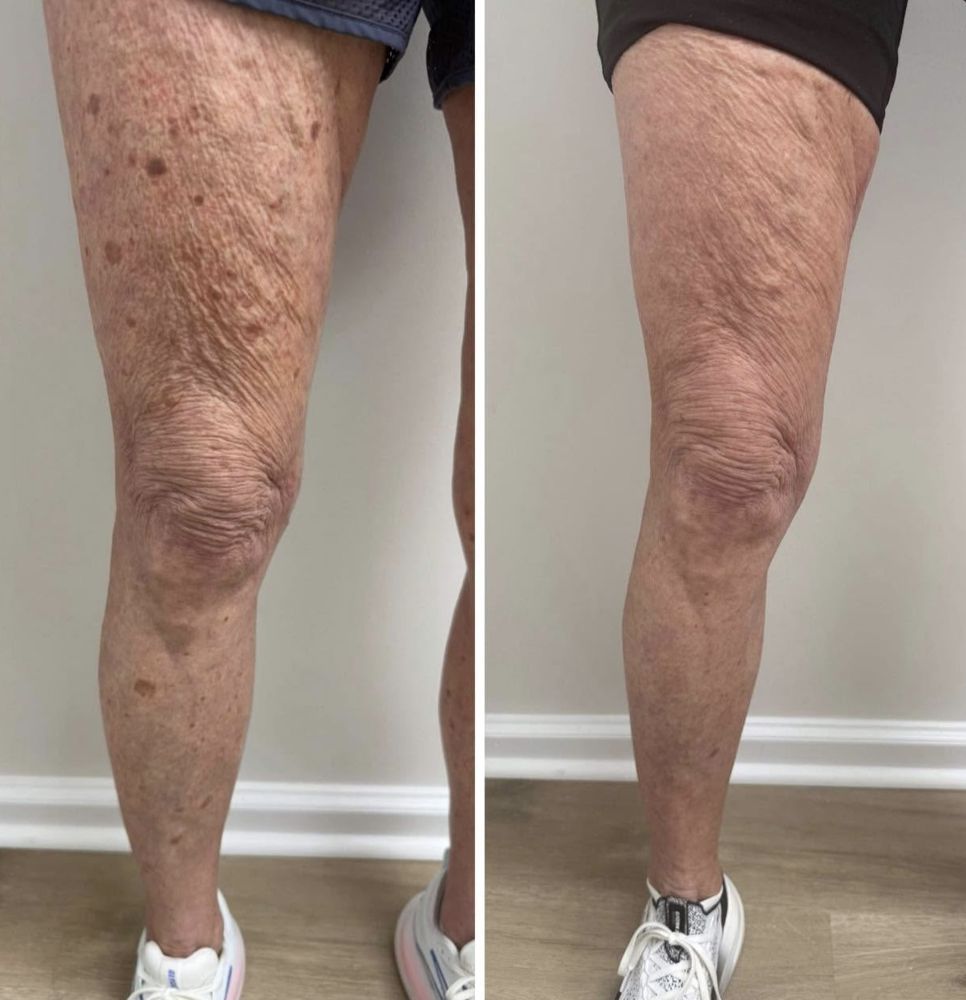 Before and after — IPL Laser, sun damage — legs
