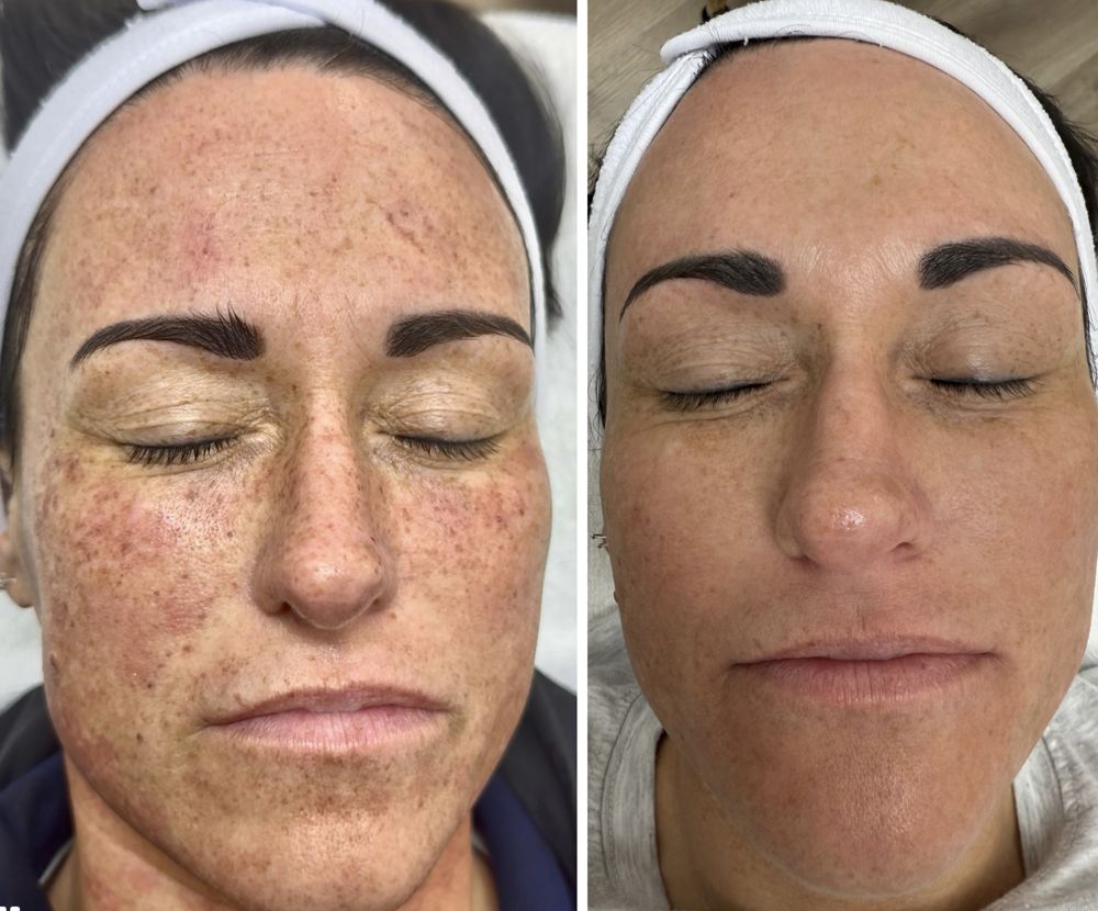 Before and after — IPL Laser, freckling & sun damage