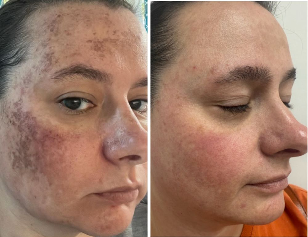 Before and after — IPL Laser, melasma & redness