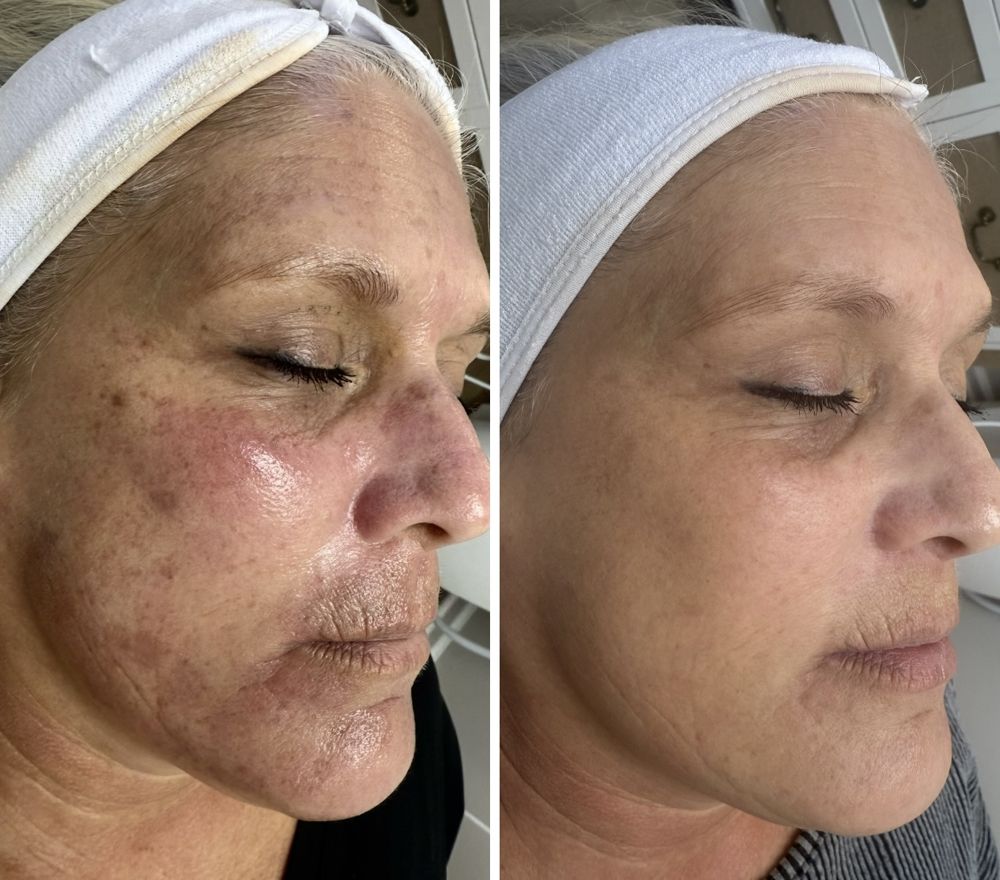 Before and after — IPL Laser, sun damage & pigmentation