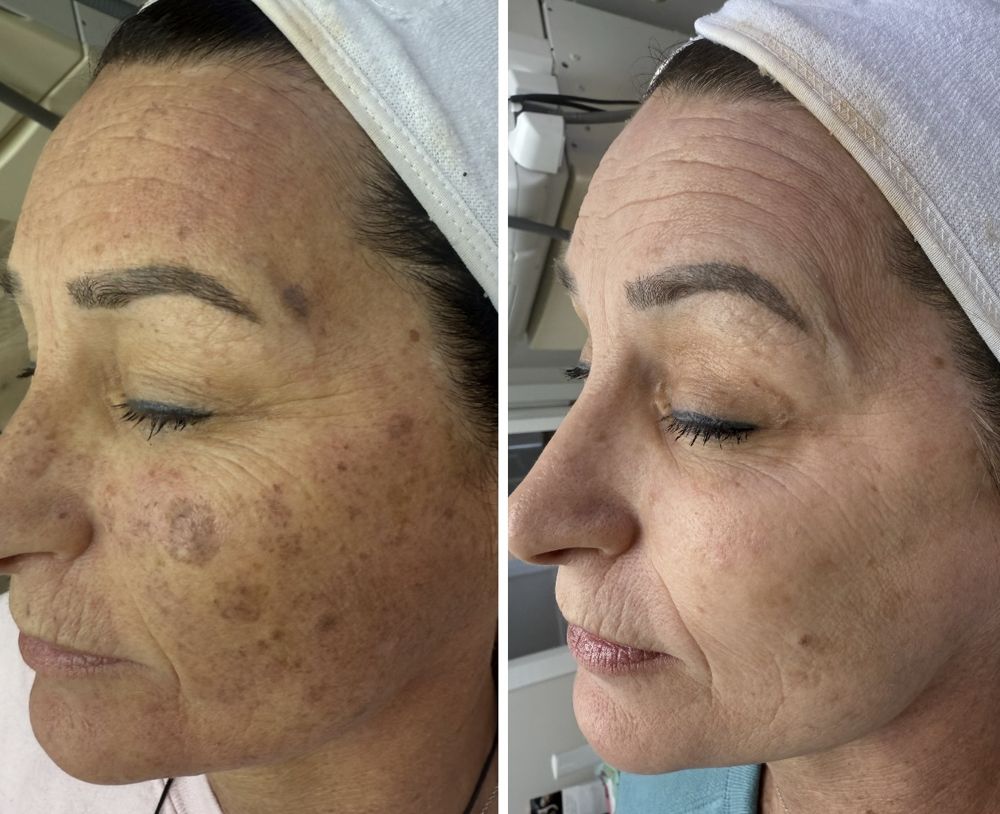 Before and after — IPL Laser, age spots & sun damage