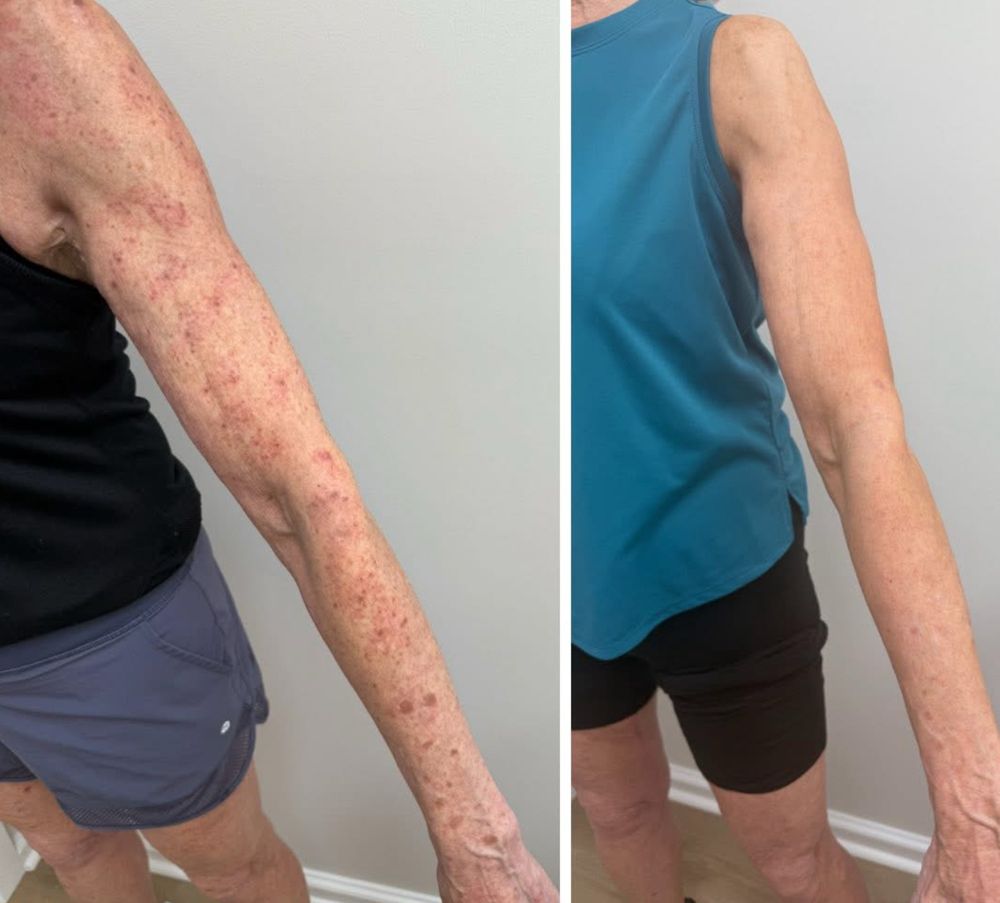 Before and after — IPL Laser, sun damage & redness — arm