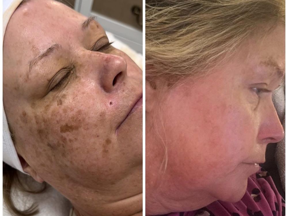Before and after — IPL Laser, pigmentation & sun damage