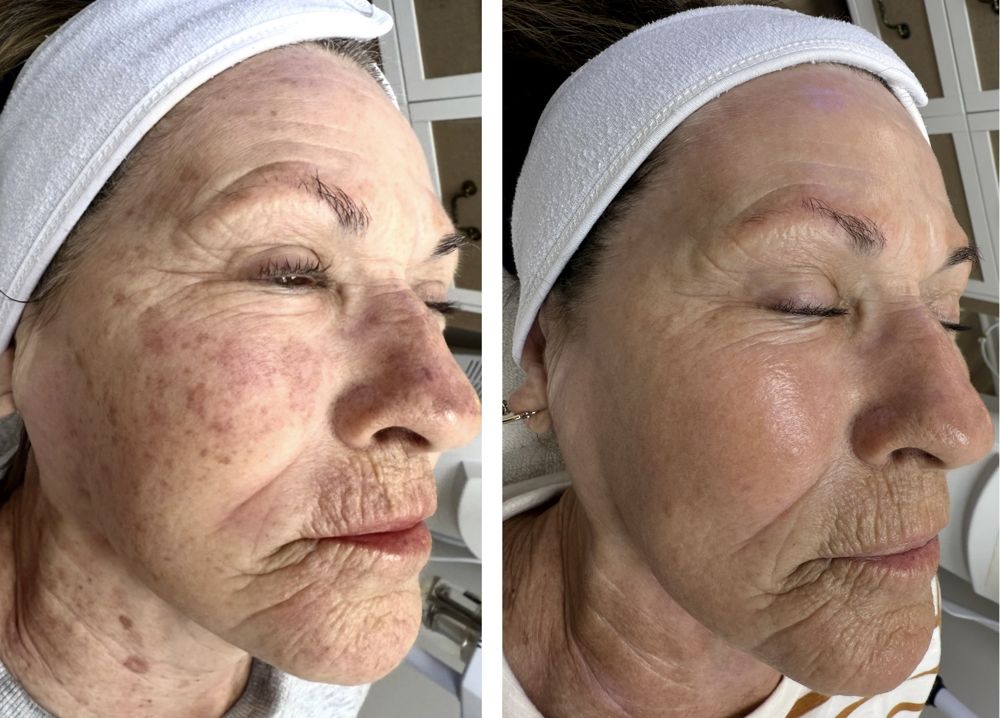Before and after — IPL Laser, sun damage & pigmentation