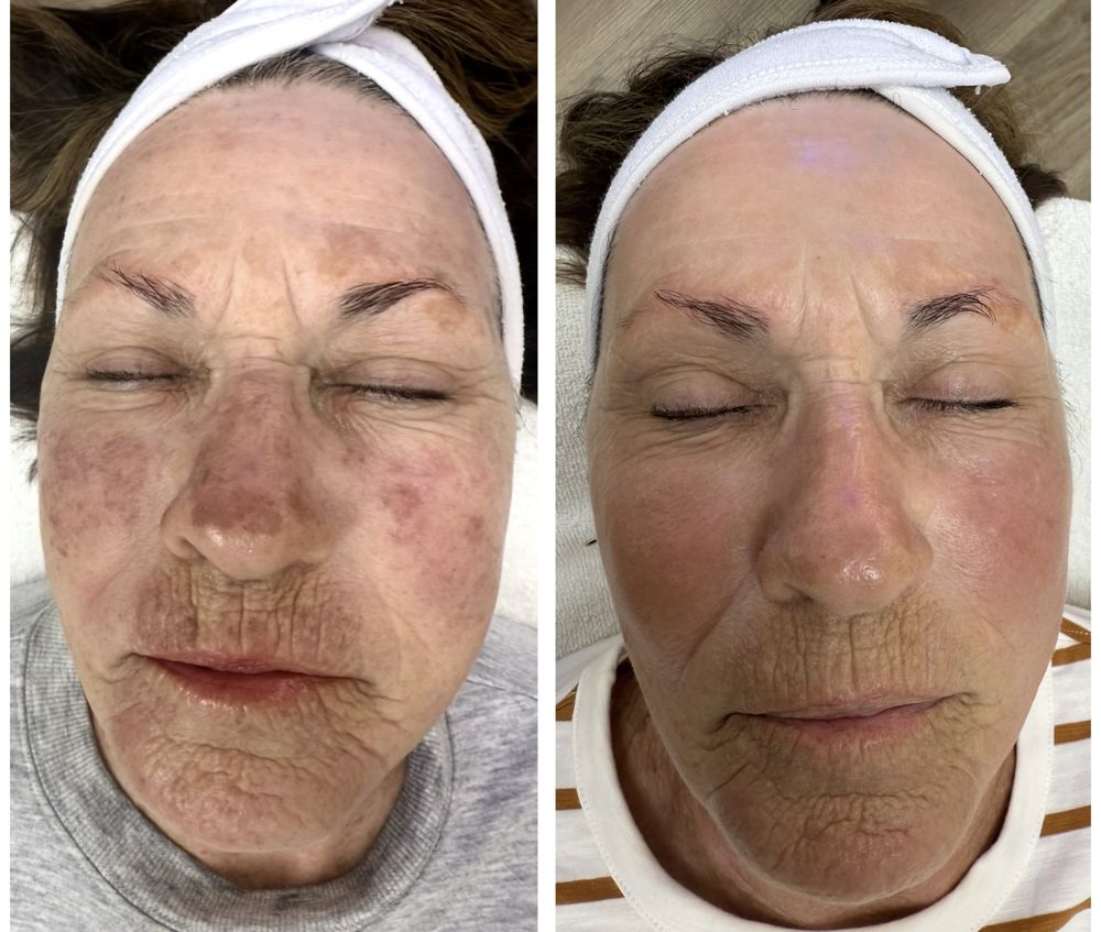 Before and after — IPL Laser, melasma & sun damage