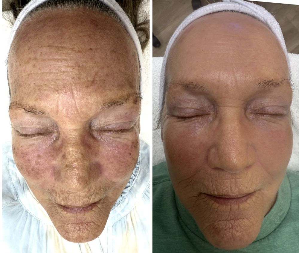Before and after — IPL Laser, sun damage & uneven tone