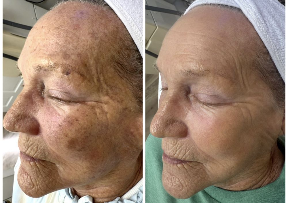 Before and after — IPL Laser, age spots & sun damage