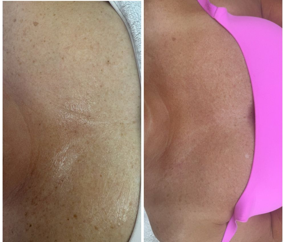 Before and after — IPL Laser, sun damage — décolleté
